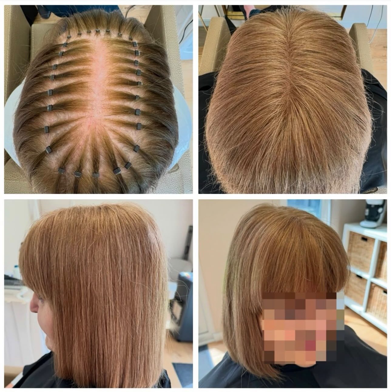 Hair loss integration transformation showing natural coverage